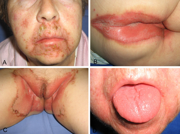 Skin eruptionsA) Erythema, scaling, erosions and crusts on the face B) Intense erythema with crusted erosions at perineum C) Polycyclic migratory lesions with scaling advancing borders at groin folds D) Glossitis[10]