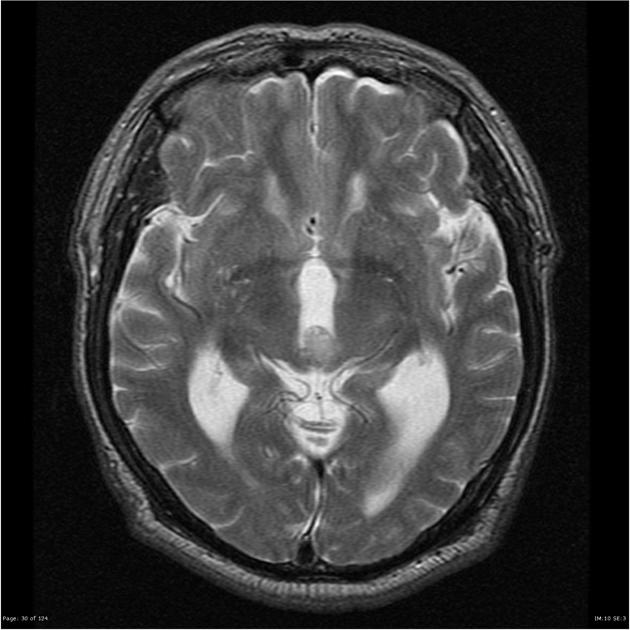 Axial T2 demonstrating a circular mass centered in pineal region measures 12 x 11 x 9 mm and demonstrates homogeneous enhancement (on volumetric sequence for stereotaxis), peripheral calcification, and diffusion restriction. It has mass effect on the adjacent structures with stenosis of the cerebral aqueduct (some flow still present on cine imaging) and associated non-communicating hydrocephalus affecting the lateral ventricles and 3rd ventricle. Foramina of Monroe are patent. No other suspicious enhancing lesion, including of the leptomeninges. No suprasellar/sellar mass in non-dedicated study.[24]