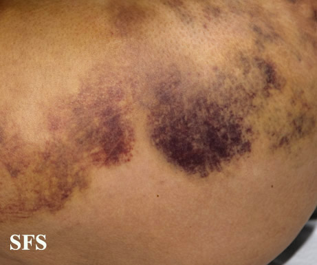 File:Painful bruising syndrome10.jpg