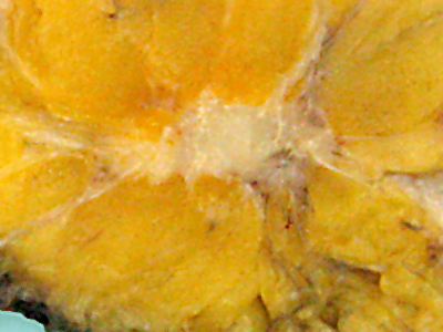 Typical macroscopic (gross) appearance of the cut surface of a mastectomy specimen containing a cancer, in this case, an invasive ductal carcinoma of the breast, pale area at the center