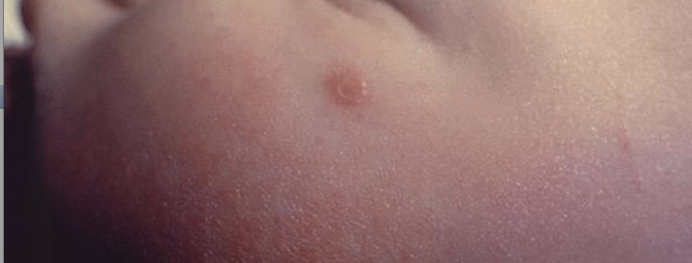 Lateral view of a 4 month-old infant’s face with a single varicella-zoster, otherwise known as chickenpox. From Public Health Image Library (PHIL). [1]