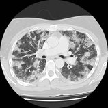 File:Choriocarcinoma lung metastasis.jpg
