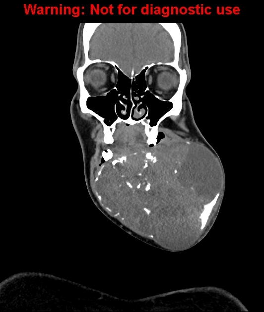 File:Coronal soft tissue window ameloblastoma.jpg
