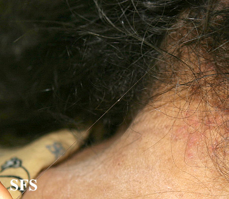 Pediculosis capitis. With permission from Dermatology Atlas.[34]