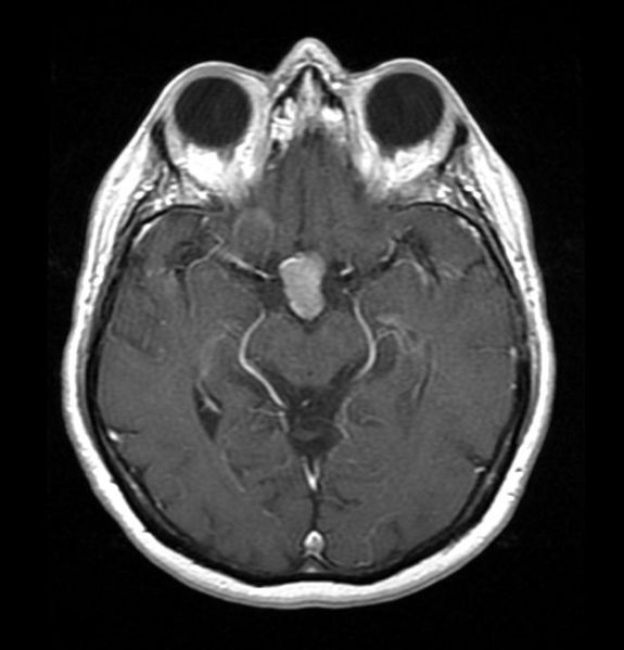 There is a well defined homogeneously enhancing lesion in the pituitary fossa on Axial T1 C+ suggestive of pituitary adenoma.[7]