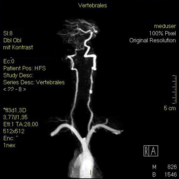 File:The vertebarobasilar artery.png