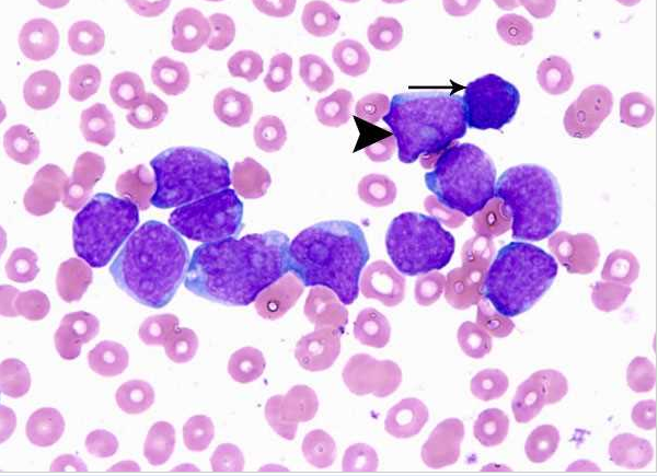 Acute myeloid leukemia-M0 - lack of obvious myeloid differentiation by routine histologic examination and presence of myeloperoxidase in <3% of blasts. Morphologically, blasts are small to large with no granules or Auer rods.