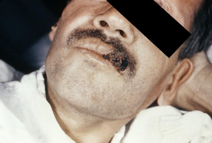 Skin lesion on the upper lip due to Histoplasma capsulatum infection.