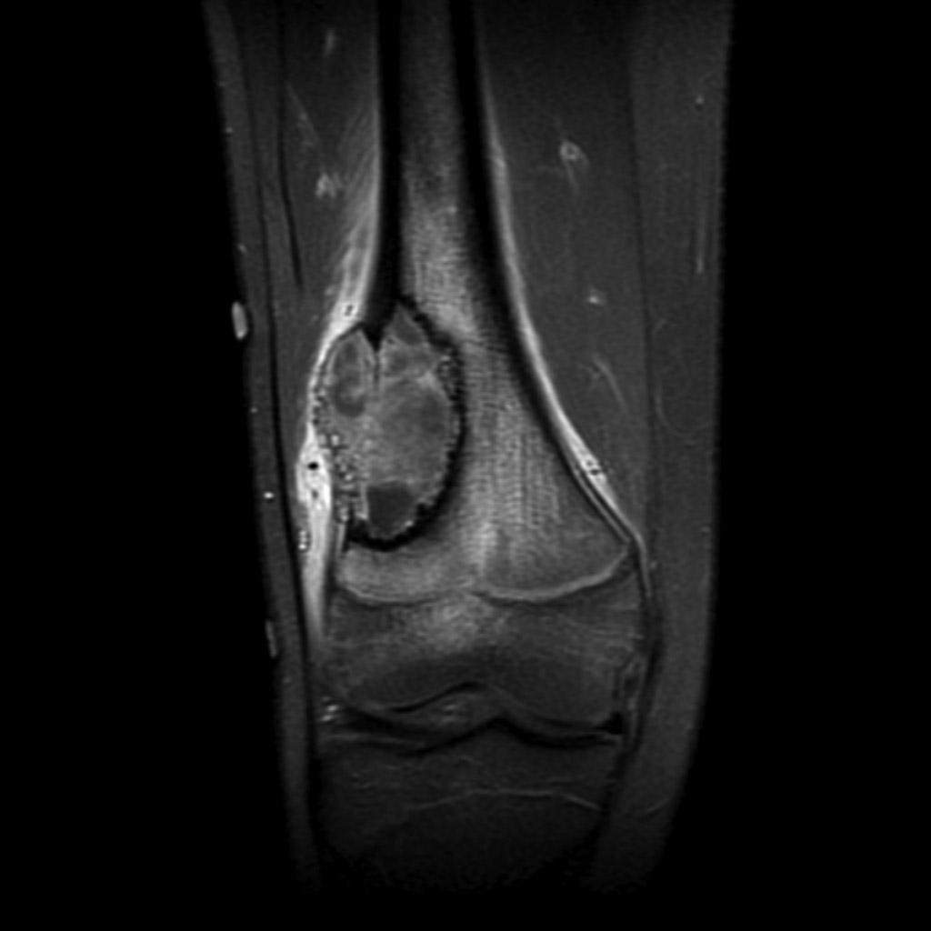 Osteosarcoma of femur MRI T1C + fat sat[2] http://radiopaedia.org/articles/osteosarcoma