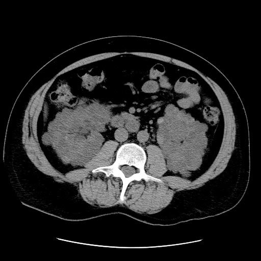 File:Polycystic-kidneys-003.jpg