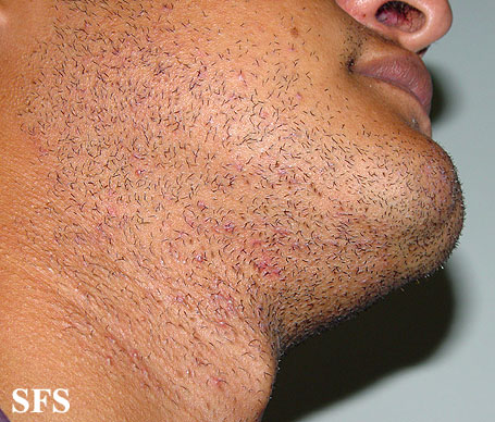 Pseudofolliculitis barbae. Adapted from Dermatology Atlas.[1]