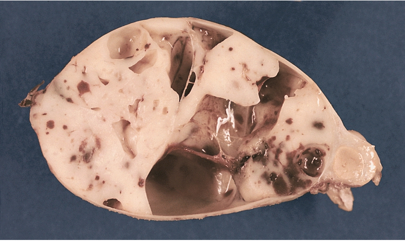 MEDIASTINUM: ENCAPSULATED CYSTIC THYMOMA. Post-formalin-fixed cut surface reveals an ivory-colored tumor with multiple cystic spaces varying from pin-head sized to a few centimeters in diameter. Small hemorrhages are also noted.