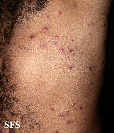 Vasculitis leukocytoclasia. From Public Health Image Library (PHIL). [3]