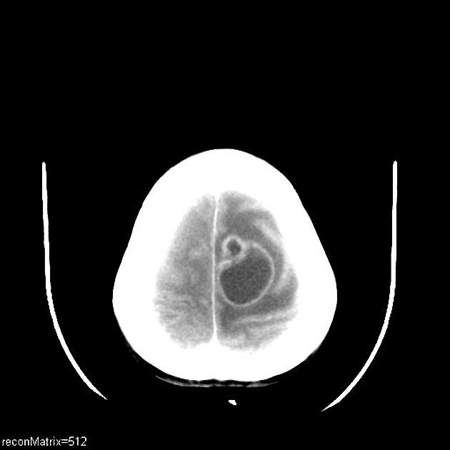 Post contrast CT of a 36 year old female, a known case of esophageal cancer, presenting with headache and right sided hemiparesis, demonstrates a ring-enhancing cystic lesion (37 x 31 mm) in the left high frontal lobe with significant perilesionalvasogenic edema causing mass effect in the form of sulcal effacement and subfalcine herniation.[6]