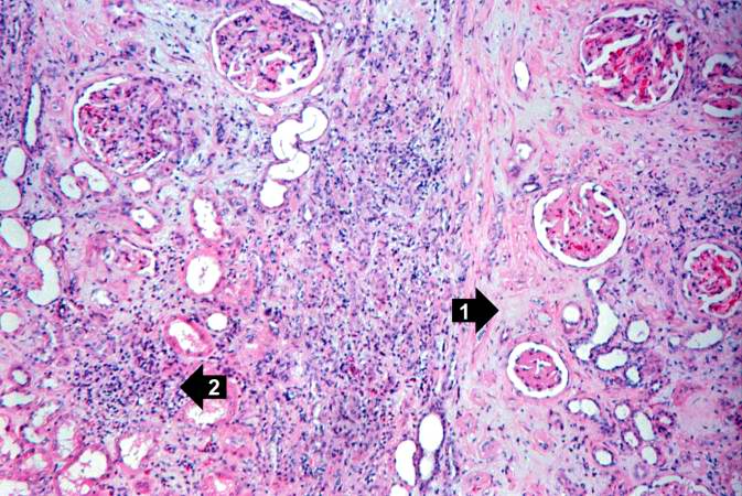 This is another area of renal cortex similar to the previous image. Note the fibrosis (1) and loss of renal tubules throughout this section. Also note the focus of inflammatory cells (2) indicating that despite the chromic nature of this lesion, there is still ongoing active rejection and renal damage.