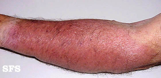 Erysipelas. Adapted from Dermatology Atlas.[7]