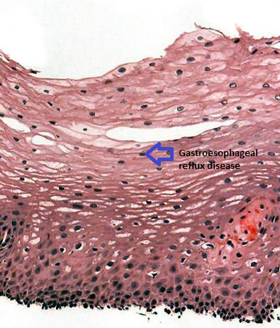 File:Gastroesophageal reflux disease.jpeg