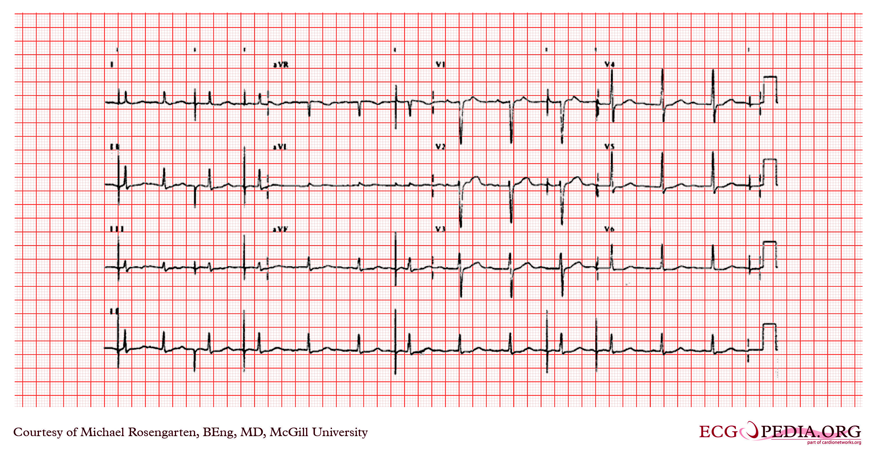 File:Paced atrial rhythm with a bipolar atrial pacemaker.jpg