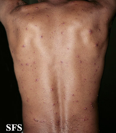 Vasculitis leukocytoclasia. From Public Health Image Library (PHIL). [2]