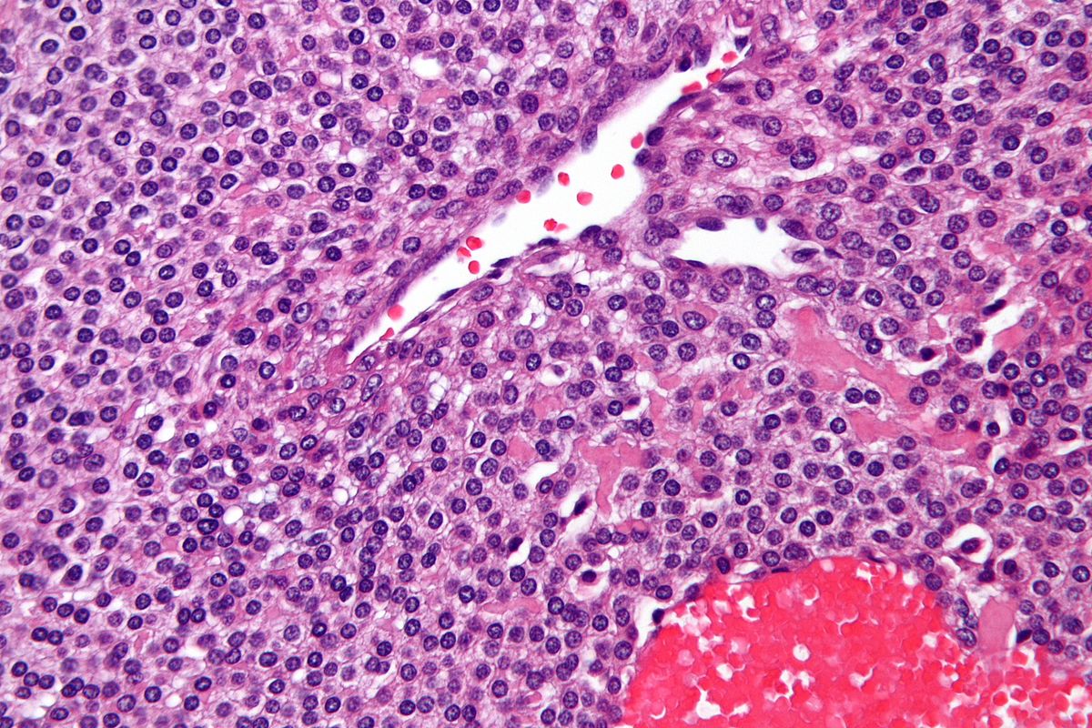 Very high magnification micrograph of a glomus tumor. H&E stain.[8]