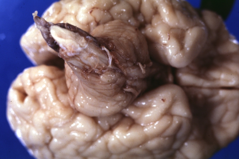 Brain: Arnold Chiari Malformation: Gross fixed tissue cerebellum and brainstem