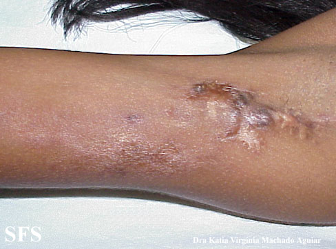 Calcinosis circumscripta. Adapted from Dermatology Atlas.[1]