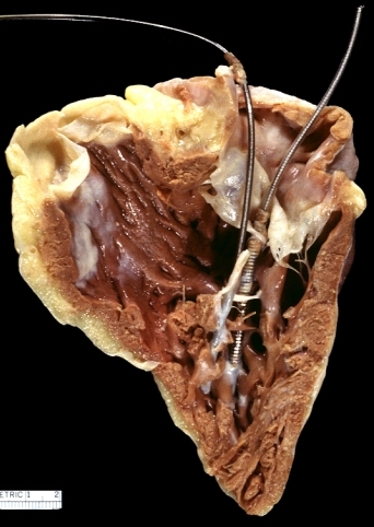 Right ventricular endocardial fibrosis due to implantable defibrillator