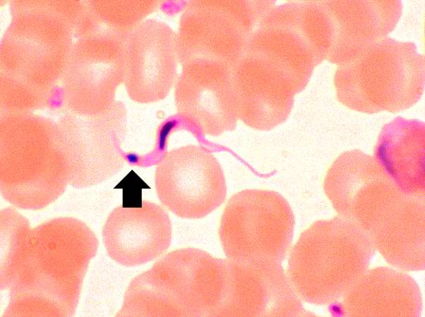 This peripheral blood smear from the patient shows a higher power view of a Trypanosoma cruzi trypomastigote. Note the prominent kinetoplast (arrow).