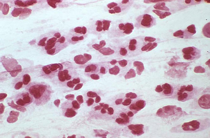 Gram stain of urethral discharge. Note that many PMNs without intracellular bacteria in favor of nongonococcal urethritis.
