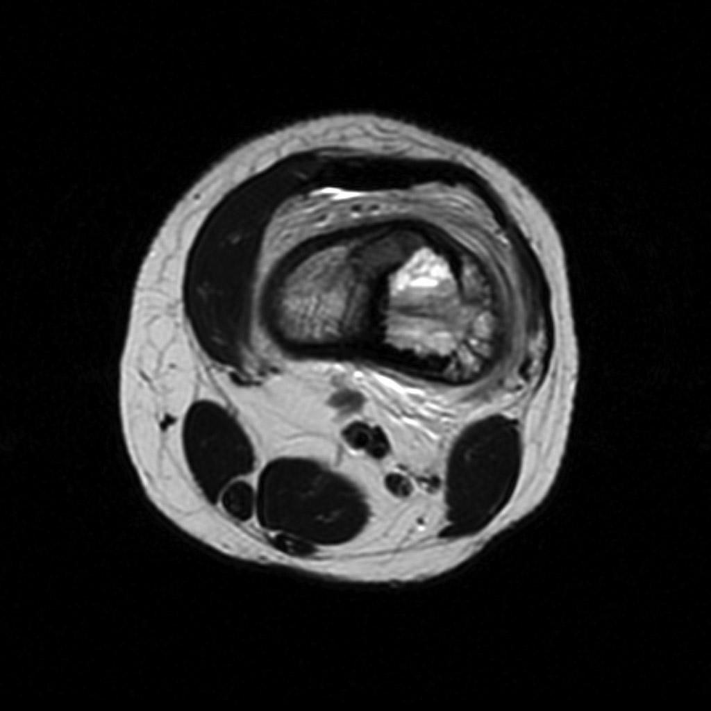 File:Osteosarcoma-distal-femur (3).jpg