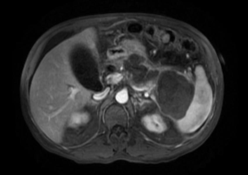 Computerized tomography: Pancreatic pseudocyst