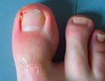 Paronychia of the big toe