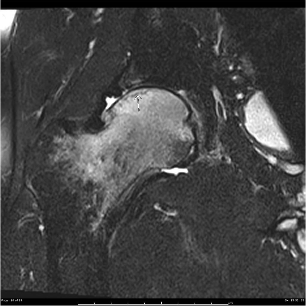Coronal T2 fat sat Extensive marrow edema within the femoral head and neck. There is a subchondral fracture within the femoral head.