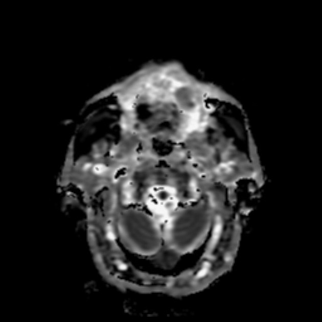 Axial apparent difusion coefficient MRI of squamous cell carcinoma of tongue [5]