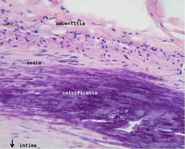 Microphotography of arterial wall with calcified (violet colour) atherosclerotic plaque (haematoxillin & eosin stain)