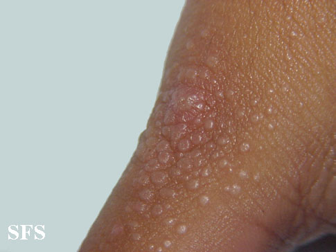 Lichen nitidus. Adapted from Dermatology Atlas.[8]