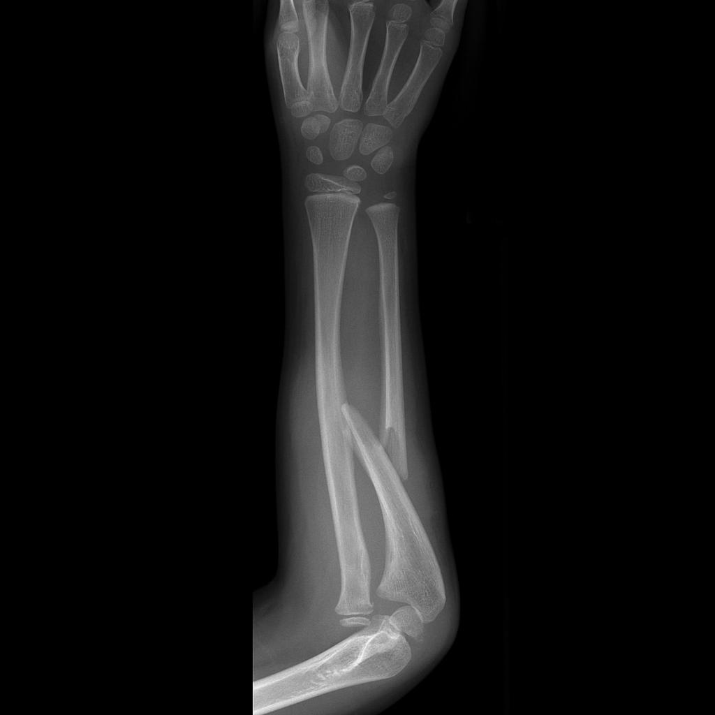 Monteggia fracture-dislocation- A displaced and overlapped fracture of the ulnar shaft is present. Additionally the radial head is dislocated anteriorly.