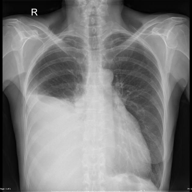 Large unilateral right sided effusion. Heart is enlarged, especially the left lateral appendage. - Case courtesy of A.Prof Frank Gaillard, <a href="https://radiopaedia.org/">Radiopaedia.org</a>. From the case <a href="https://radiopaedia.org/cases/24290">rID: 24290</a>