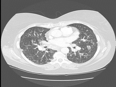 File:Sarcoidosis lung.gif