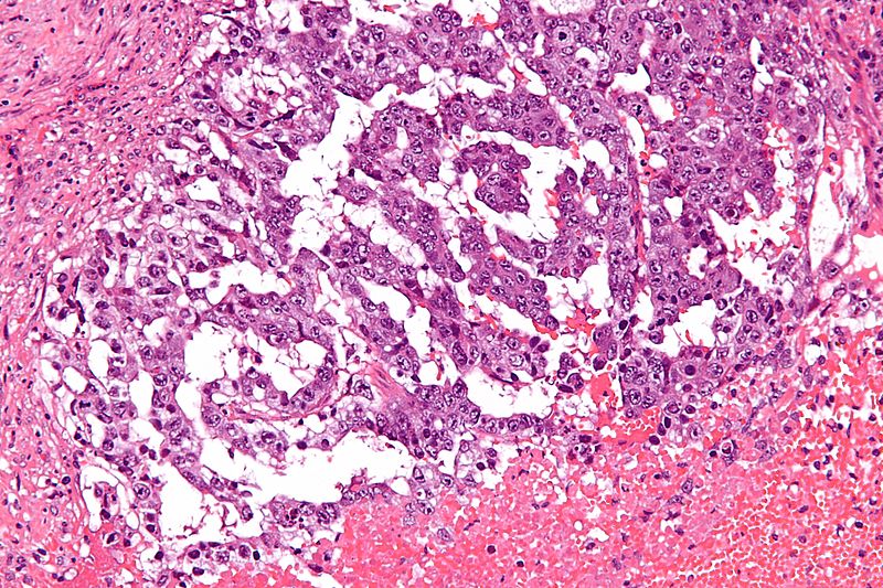 File:800px-Mixed germ cell tumour - high mag.jpg