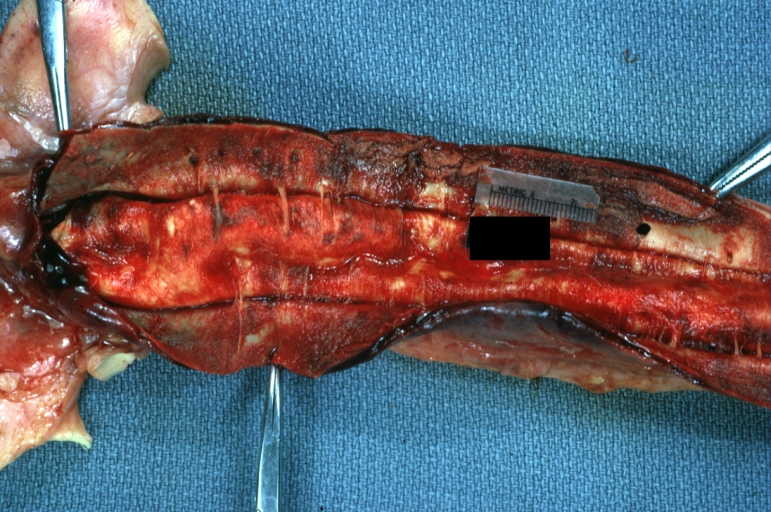 Dissecting Aneurysm: Gross very good example dissected channel has been opened.