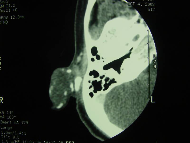 Axial CT scan cut shows a density in the right auricle representing the chondroma [2].