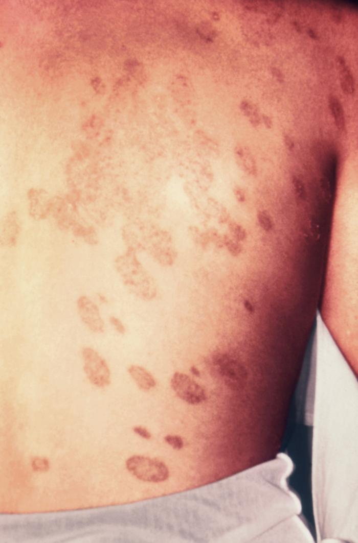 Lesions that were diagnosed as ringworm, attributed to a dermatophytic fungal organism, Trichophyton verrucosum. From Public Health Image Library (PHIL). [6]