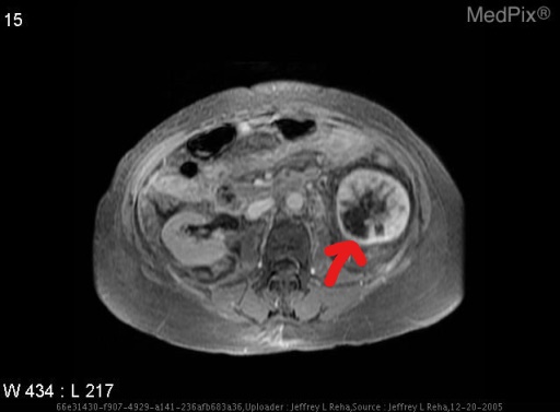 File:InkedMRI renal oncocytoma LI.jpg