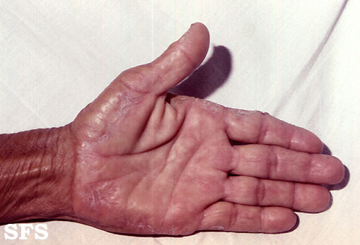 Marginal keratoderma of the palms. With permission from Dermatology Atlas.[1]