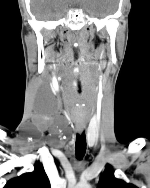 File:Papillary thyroid cancer with nodal metastasis.jpeg