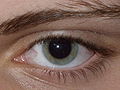 File:Result of Dilated fundus examination.JPG