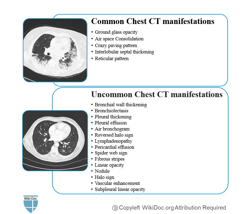 CT-FINDINGS-COVID-19.PNG