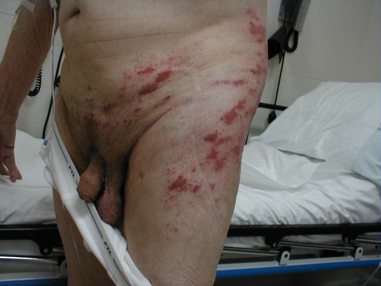Herpes Zoster: Dermatomally distributed vesicles, many of which have coalesced, in patient with HZV infection.