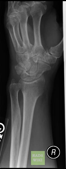 Triquetral fracture Image courtesy of RadsWiki and copylefted